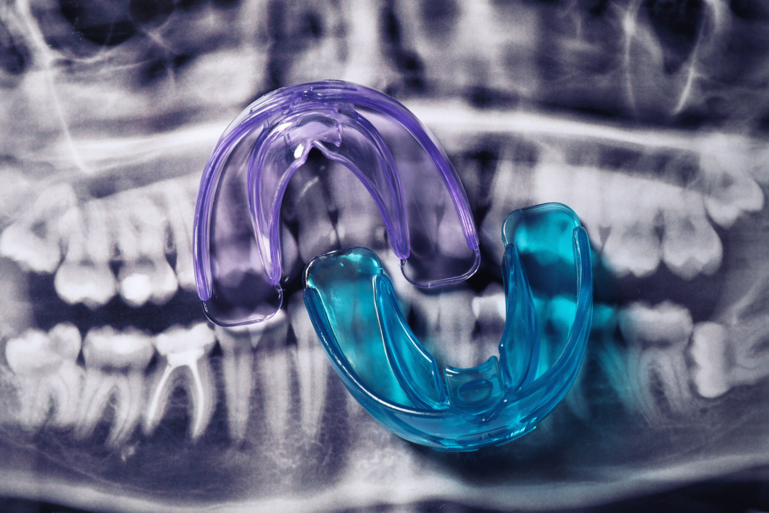 Zahnfehlstellungen: Überbiss, Unterbiss, Kreuzbiss, Offener Biss Behandlungsmethoden: Zahnspangen (feste und lose), Aligners (z. B. Invisalign) Diagnose: Kieferorthopädische Untersuchung, Röntgenbilder, Cephalogramm Wachstumssteuerung: Wachstumsplanung, Kieferwachstumssteuerung bei Kindern Retention: Haltegeräte, Retentionsmaßnahmen nach der Behandlung Ästhetik: Einfluss auf das Lächeln, gesunde Zahnpflege Kiefergelenk: TMD (Temporomandibuläre Dysfunktion) Interdisziplinäre Zusammenarbeit: Zahnärzte, Kieferchirurgen, Logopäden Patientengruppen: Kinder, Jugendliche, Erwachsene Nachsorge: Regelmäßige Kontrollen, Mundhygieneanweisungen
